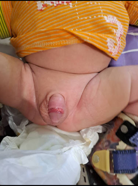 تورم طبیعی در روزهای بعد جدا شدن حلقه