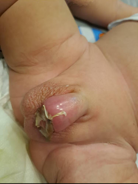 تورم طبیعی در روزهای بعد